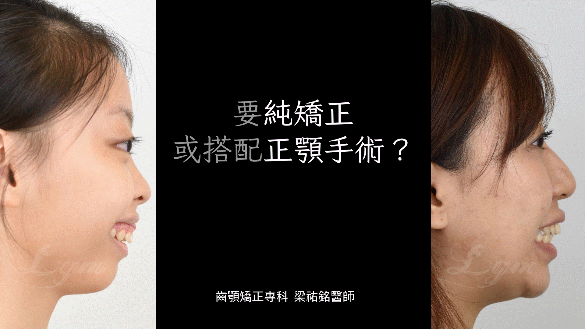 正顎手術與否的選擇