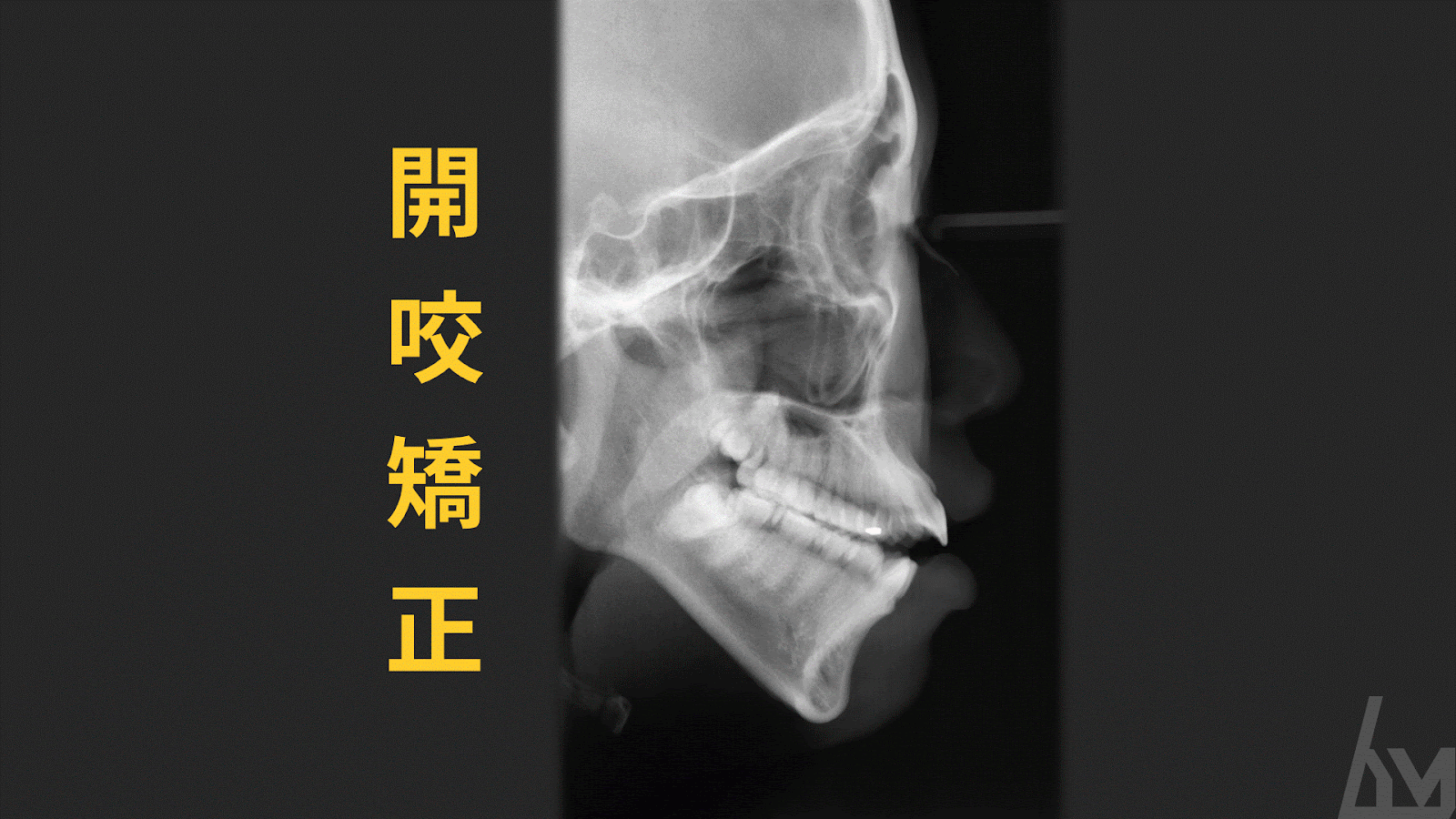矯正開咬，下巴更立體