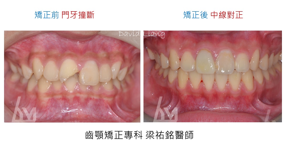 小下巴上顎門牙撞斷後的功能性矯正