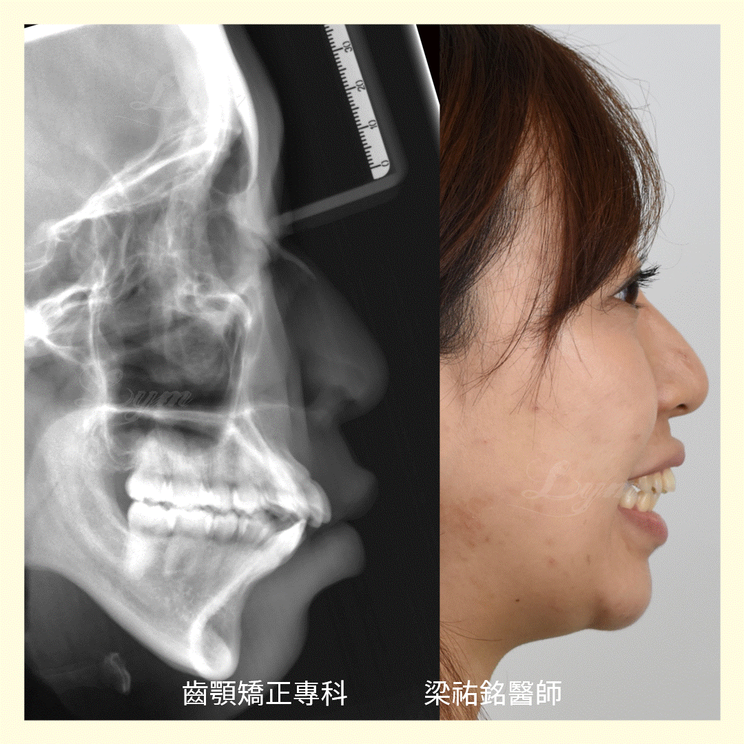 二級骨性關係純矯正改善 治療後