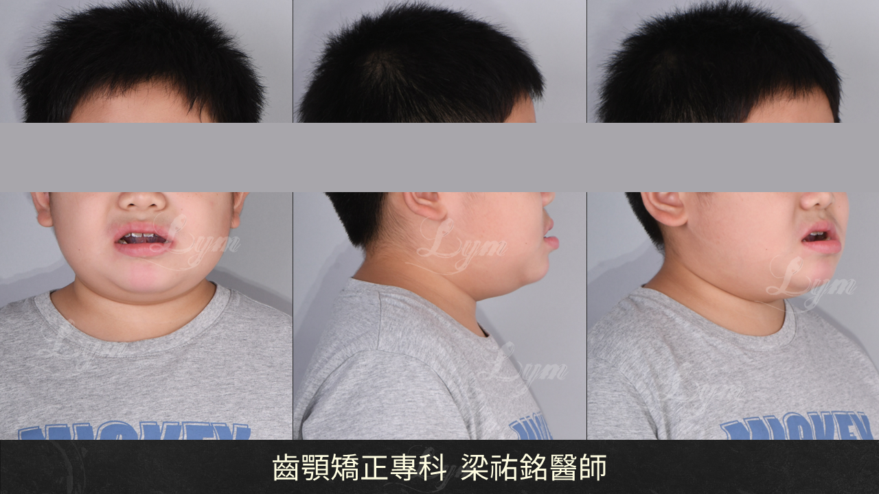 【肌功能訓練合併隱適美治療】你也做得到