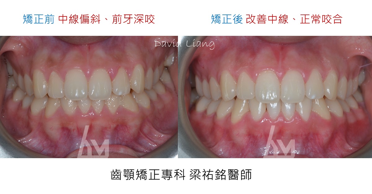 【隱形矯正案例】前牙深咬/中線偏斜/暴牙改善 治療後