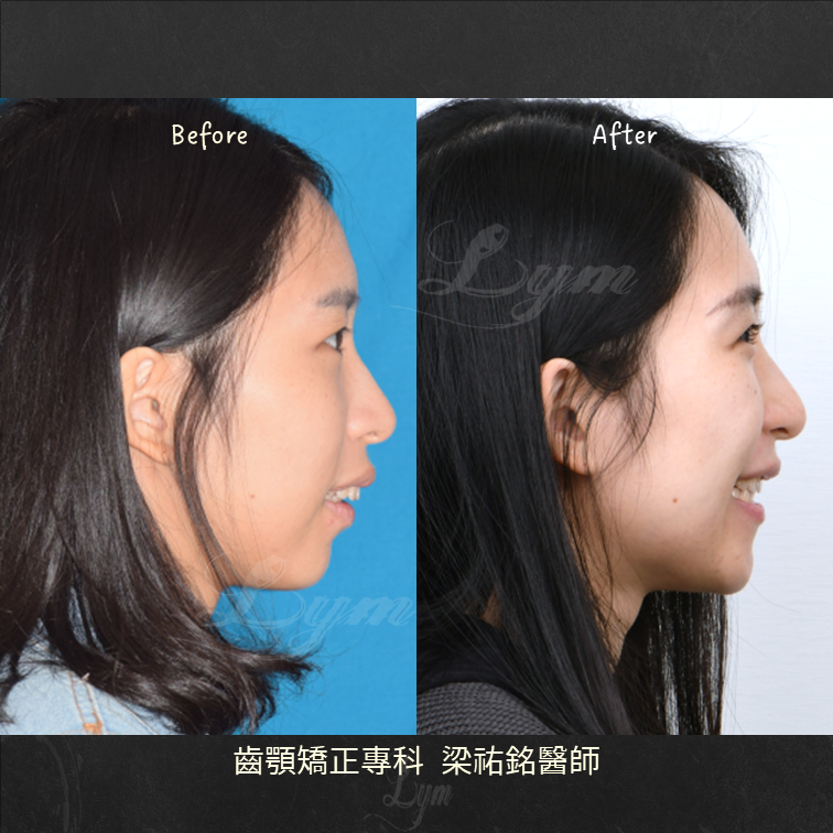 下顎旋轉及不對稱拔牙