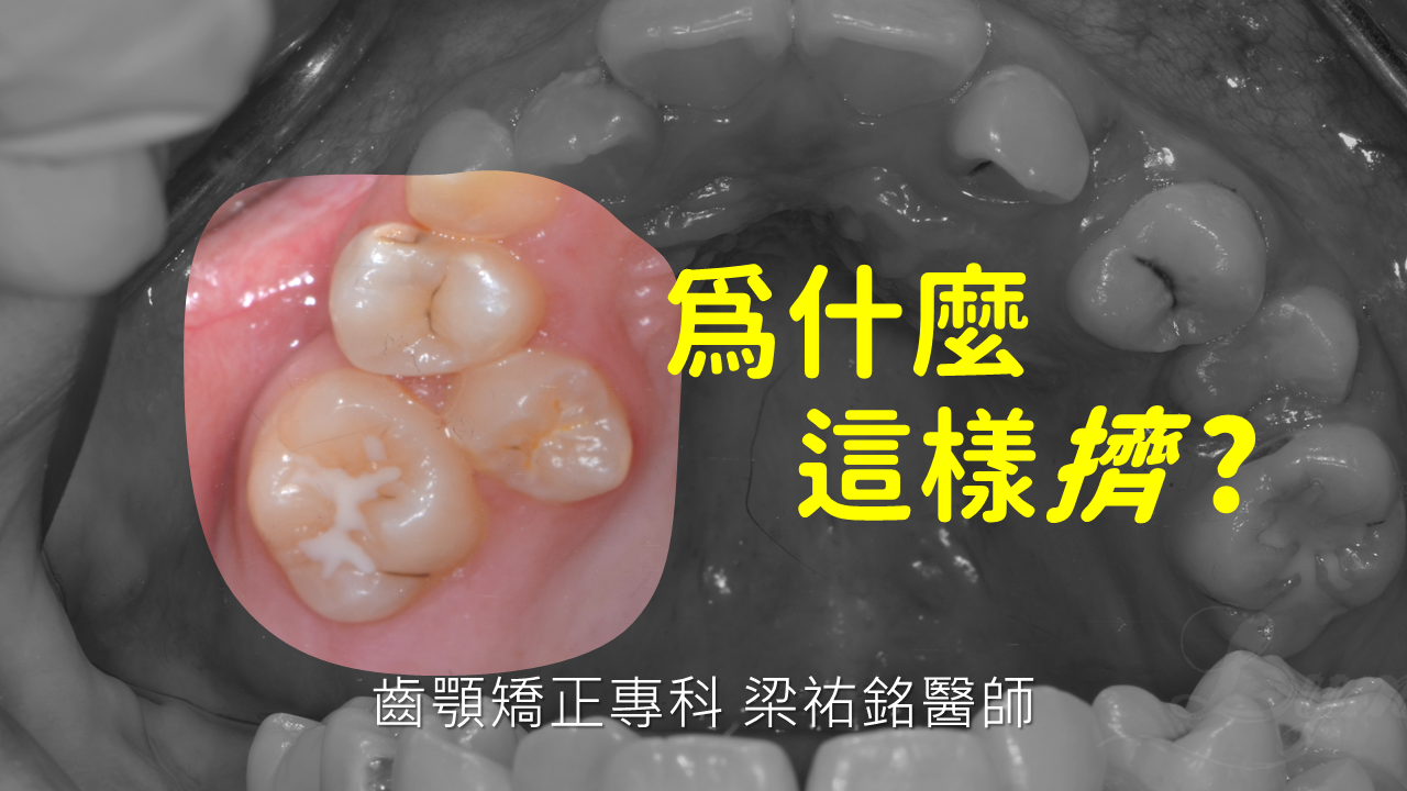 為什麼會這麼擠？【阻生小臼齒怎麼處理】
