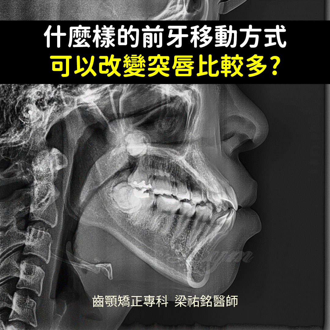 不同的前牙移動對於唇形的影響 治療後