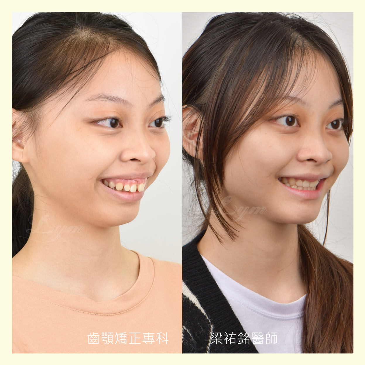小下巴一定要正顎手術嗎？