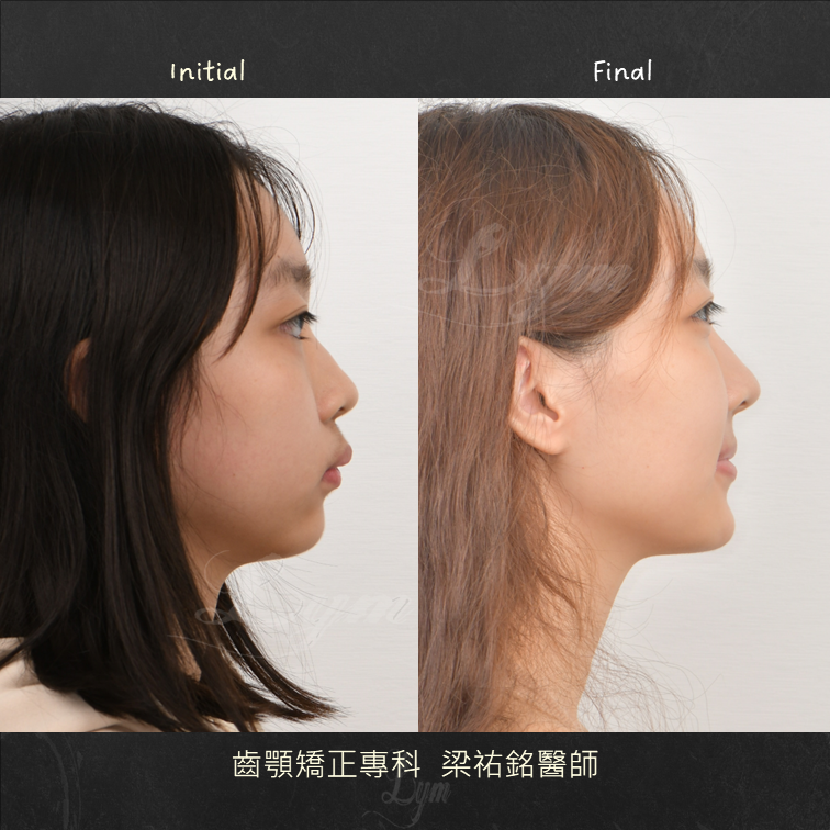 咬合平面側面傾斜度與暴牙改正 治療後