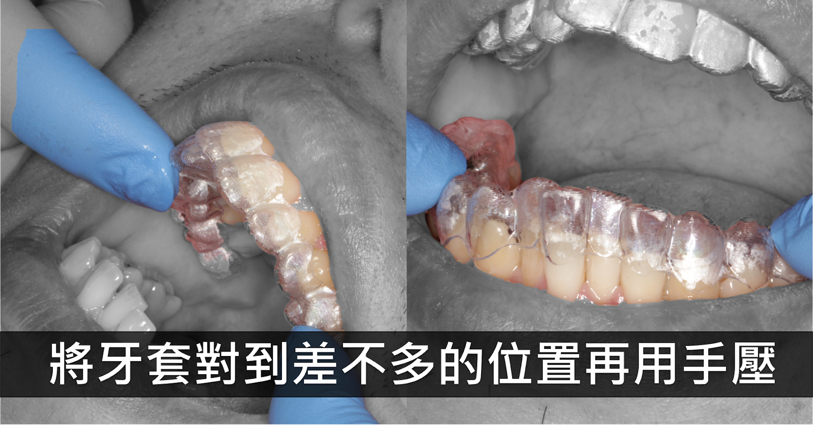 隱形矯正注意事項