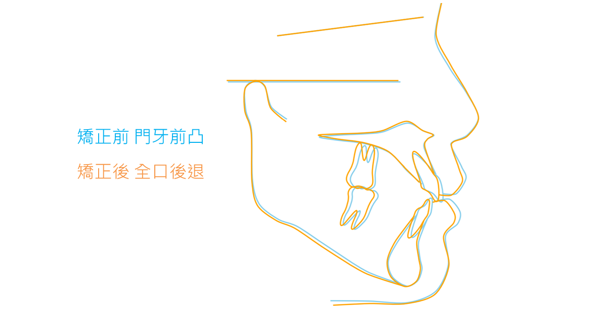 【隱形矯正案例】不拔牙全口後退 治療後