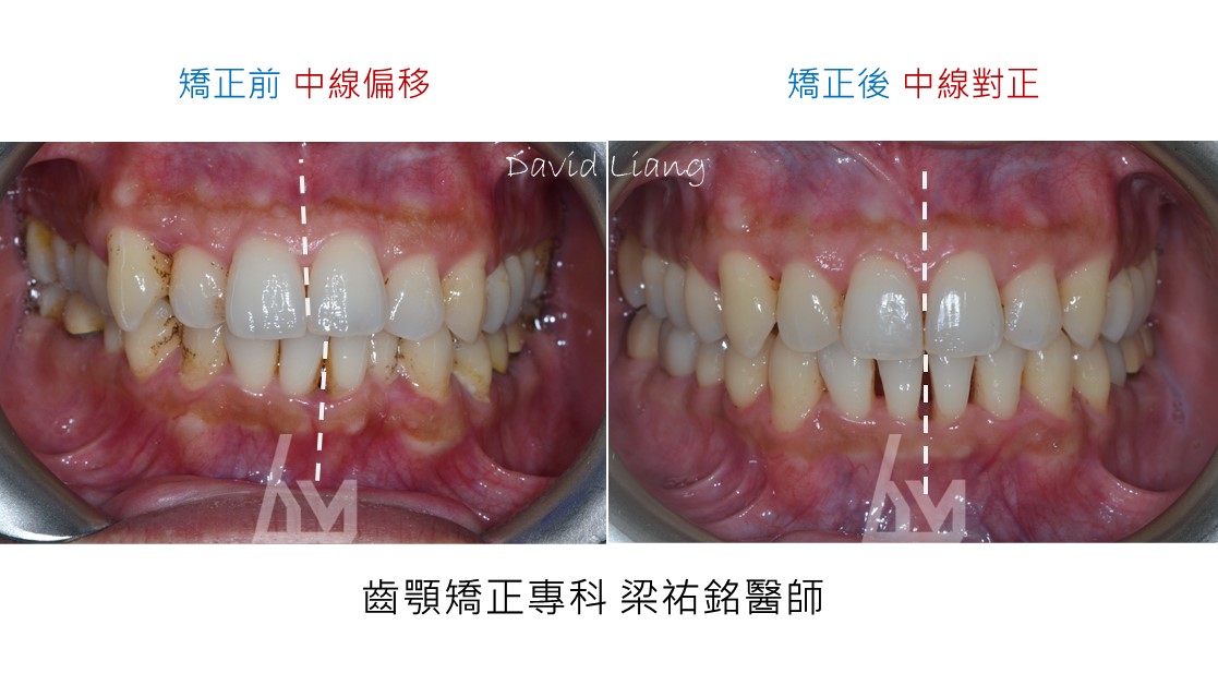 【隱形矯正案例】齒列凌亂壯齡矯正 治療後