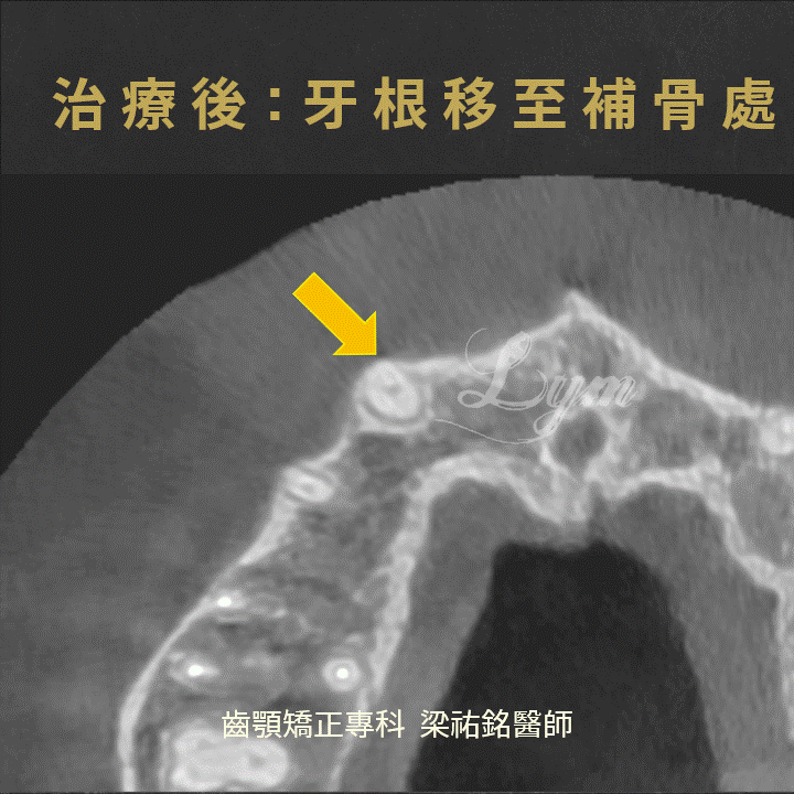 缺損骨頭需要進行矯正該如何處理 治療後