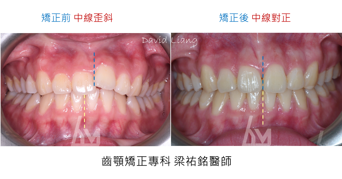 【傳統矯正案例】顏面歪斜掩飾性治療 治療後