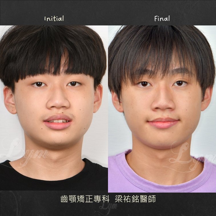 少年的小下巴隱形矯正 治療後