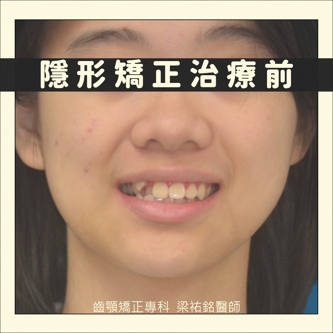 隱形矯正治療咬合平面傾斜合併顎骨偏移 治療後