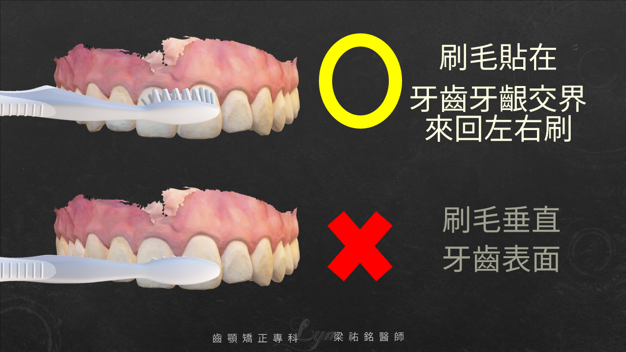 如何正確刷牙