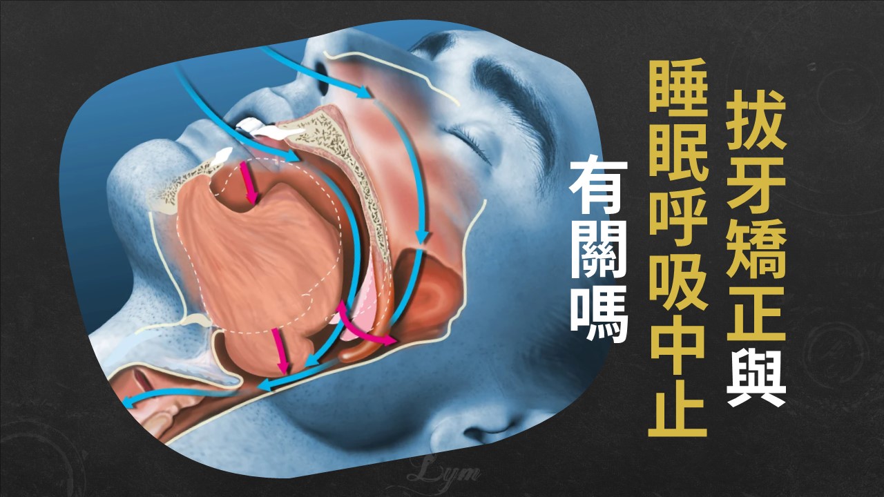 拔牙矯正與睡眠呼吸中止關係的高等級研究結論