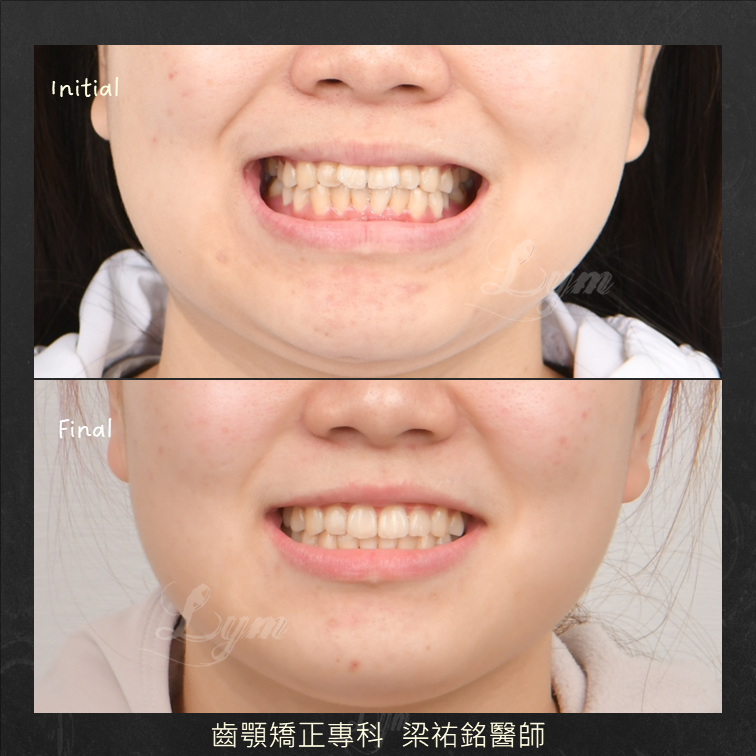 局部隱形矯正 治療後