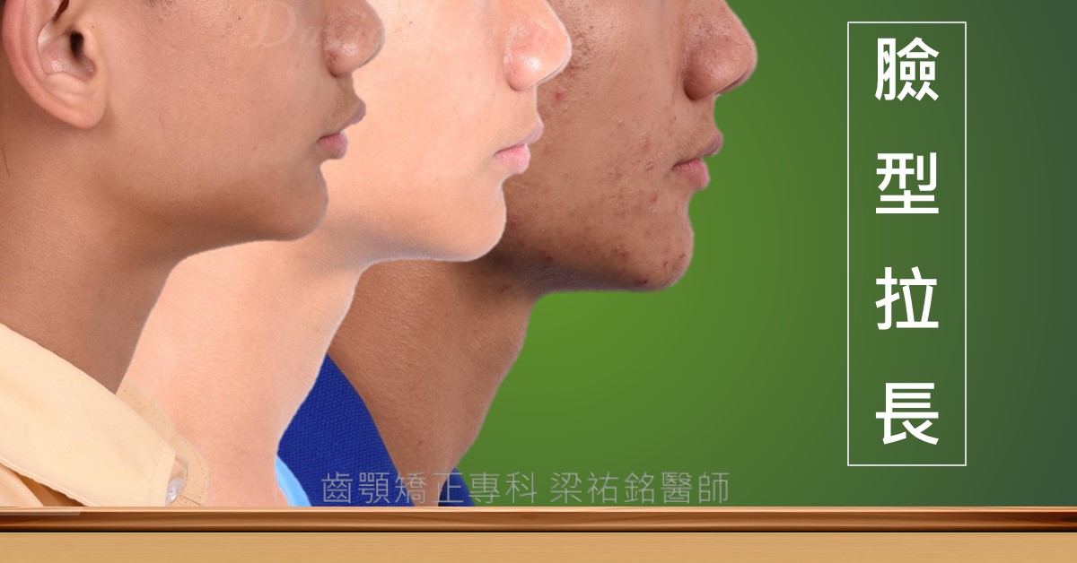 功能性矯正改善臉型