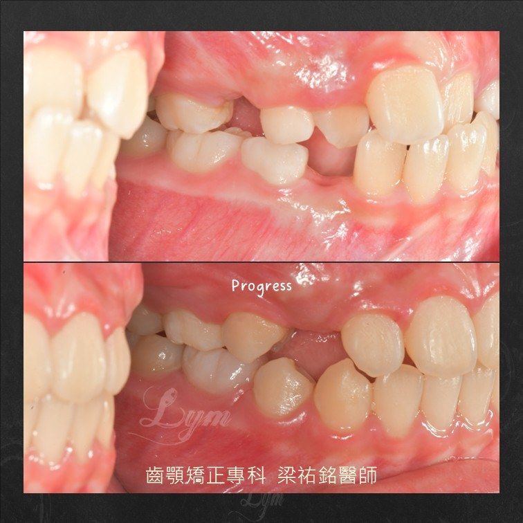 口內左側照:治療前後咬合對比