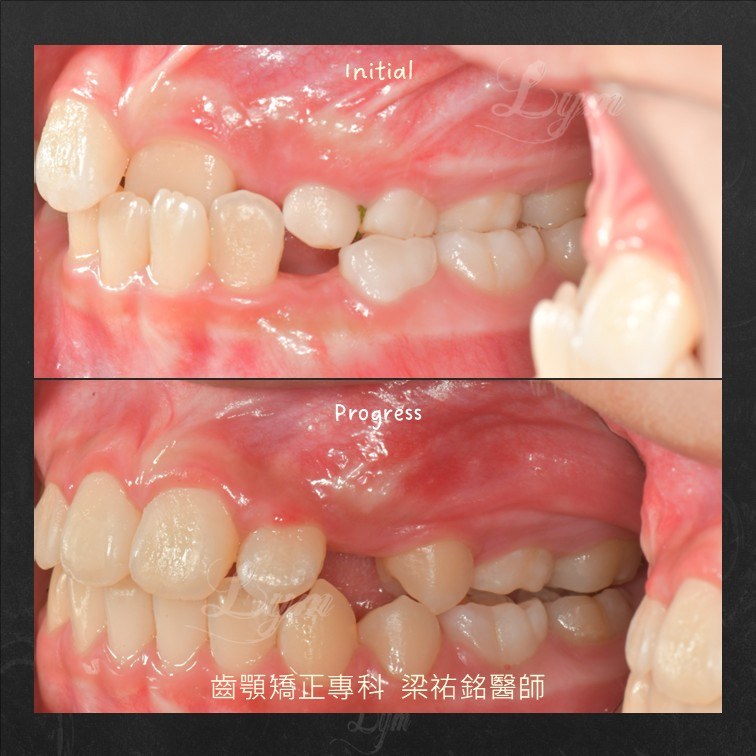 口內右側照:治療前單側後牙錯咬,治療中已改善