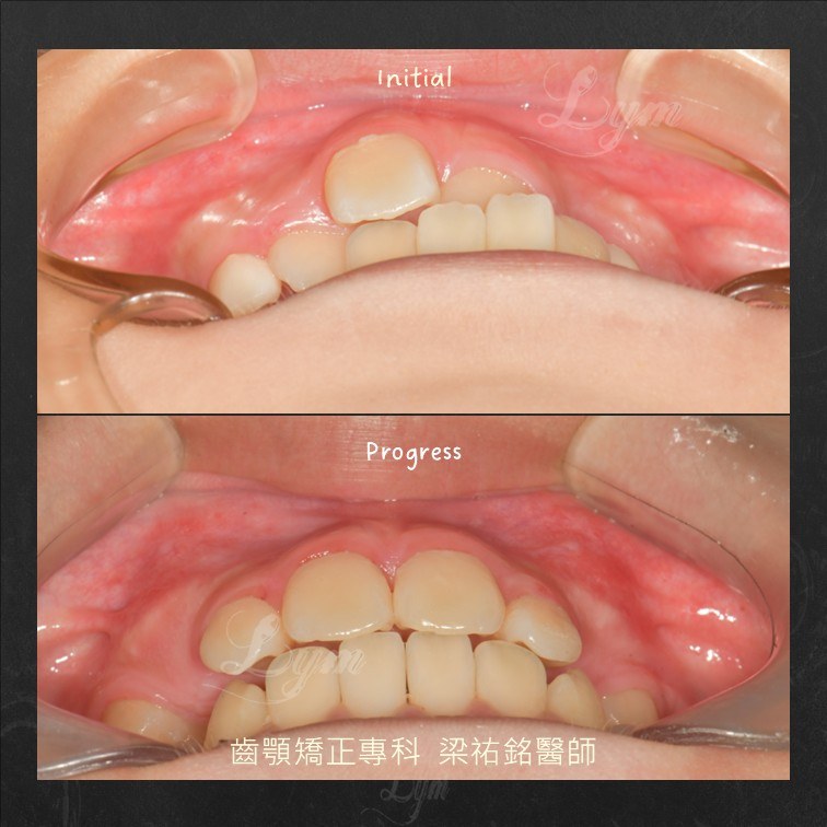 上顎前牙照:治療前後排列對比