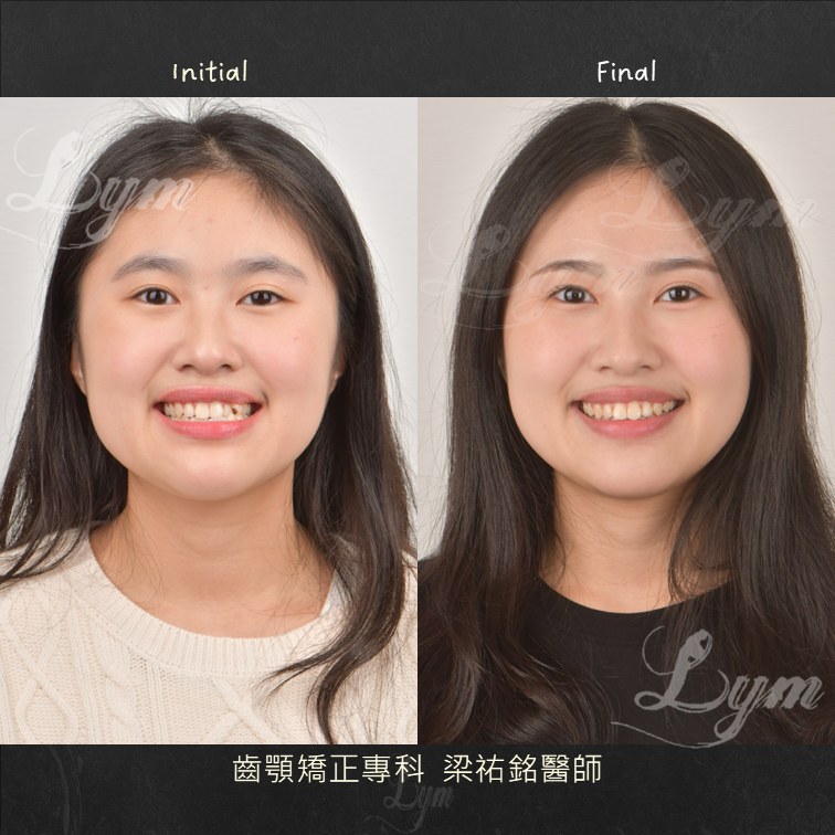 矯正一定要把牙齒往內收嗎？這個案例，我反而把門牙往外推 治療後