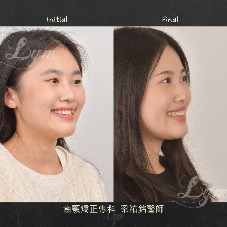 四十五度角微笑治療前後對比