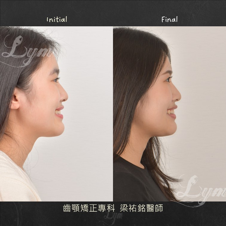 側面微笑治療前後對比:治療前下唇在上唇前方、側面偏凹;治療後上下唇關係反過來、輪廓更平衡